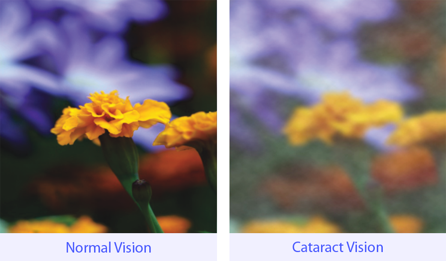 Cataracts Hinsdale Cataract Surgery Hinsdale Hinsdale Eye