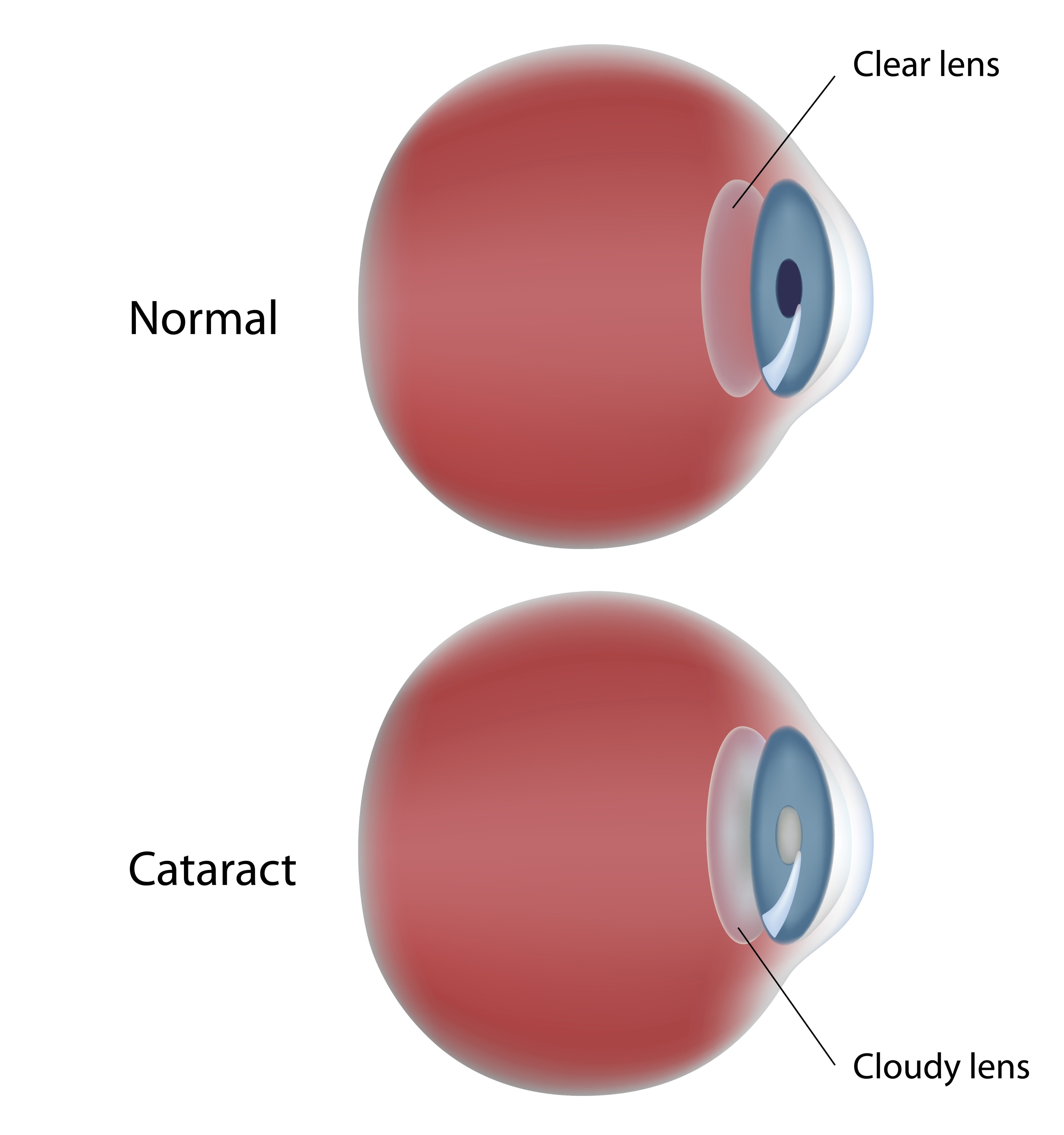 Cataract Treatment Chart