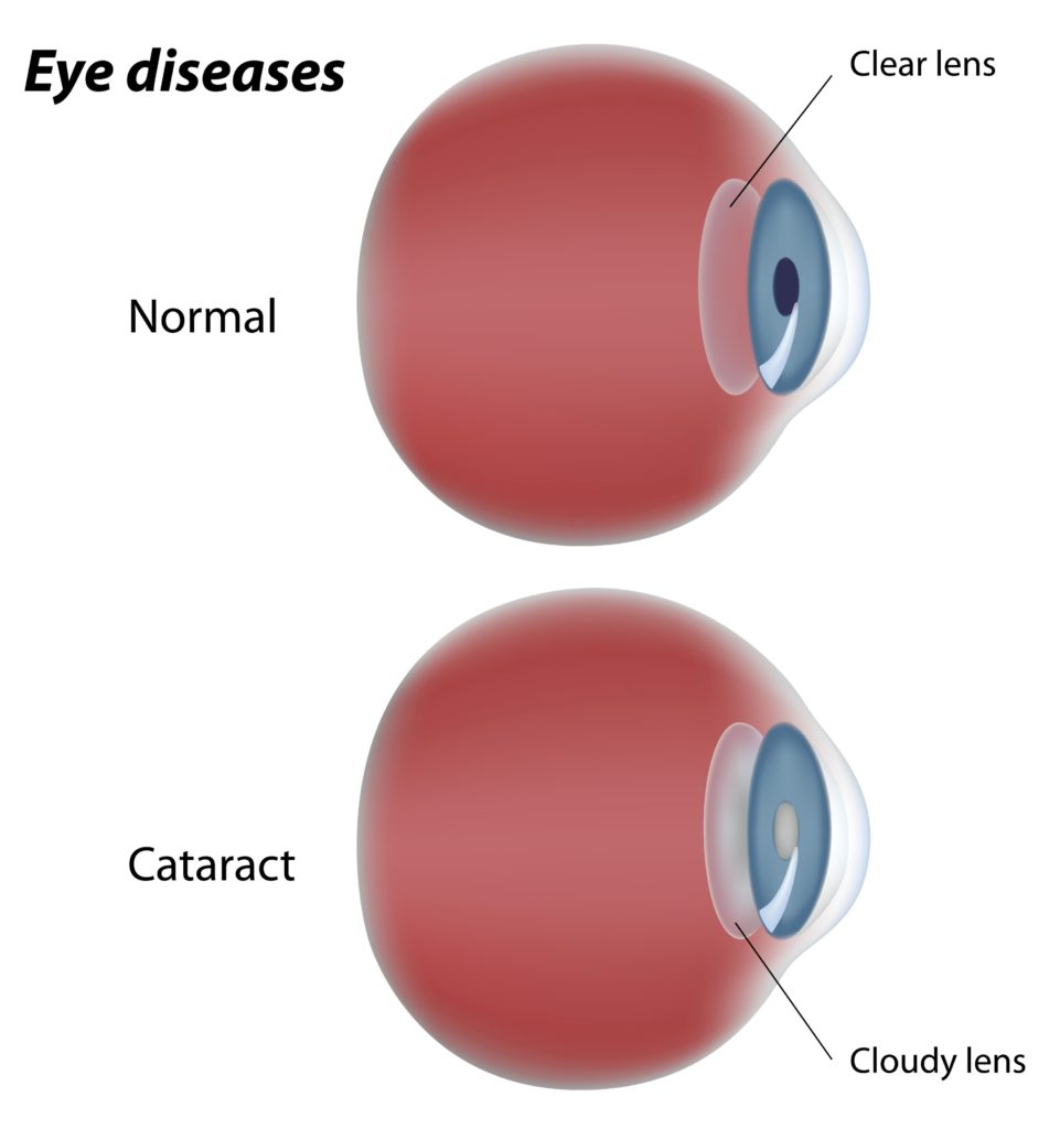 cataractchart Hinsdale Eye Center