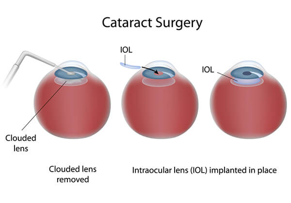 cataract-surgery-chart